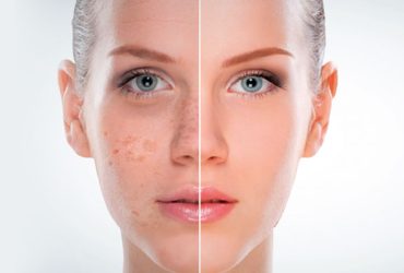 How To Treat Skin Pigmentation Safe And Naturally?