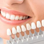 What to Expect During Veneer Placement and the Immediate Aftercare Process
