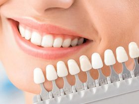 What to Expect During Veneer Placement and the Immediate Aftercare Process