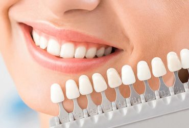 What to Expect During Veneer Placement and the Immediate Aftercare Process