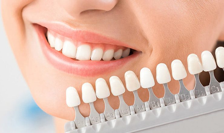 What to Expect During Veneer Placement and the Immediate Aftercare Process