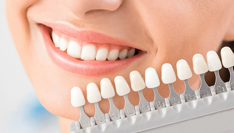 What to Expect During Veneer Placement and the Immediate Aftercare Process